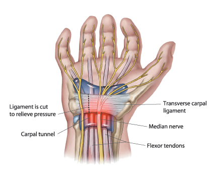 carpal syndrom treatment massage Oakville